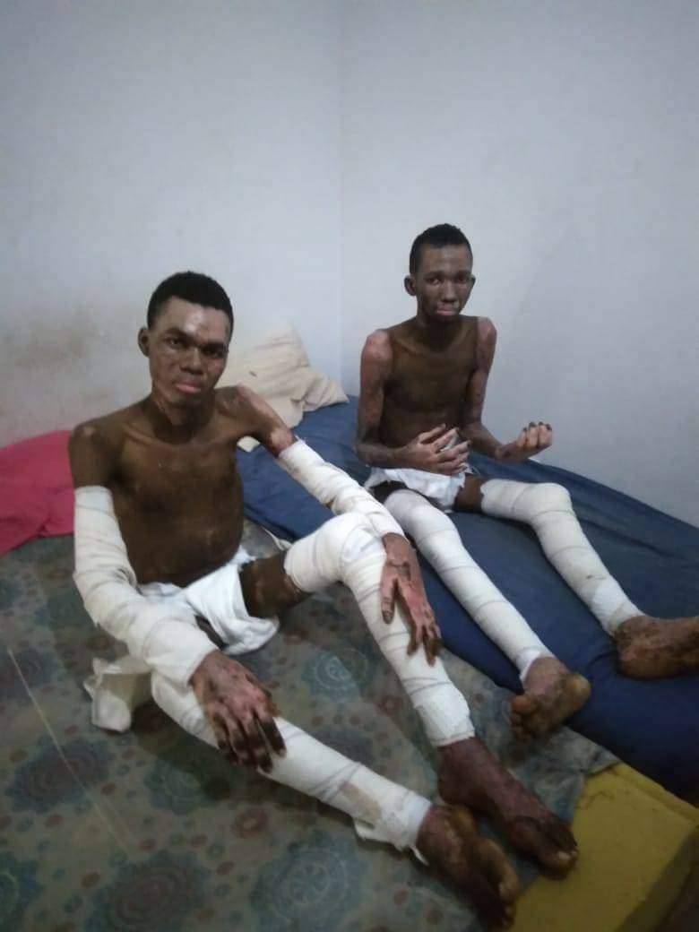 Tunis: SOS pour deux ressortissants Guinéens brûlés au 3eme degré 